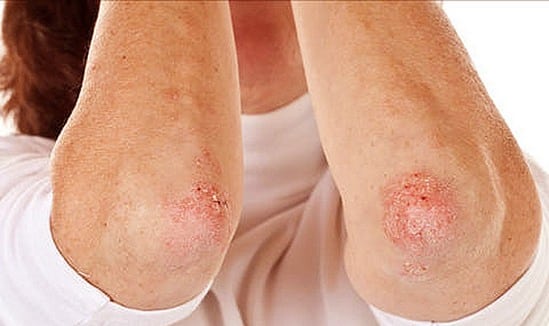 Связаны ли кандидоз и псориаз?