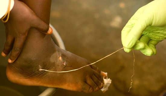 Как развивается дракункулез?