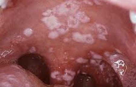 Как можно заразиться трихомониазом и как это предотвратить?