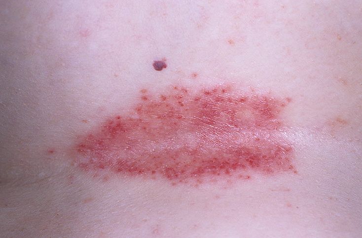 simptoma-kadidoza-pod-myshkami