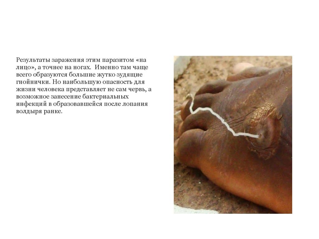 Как развивается дракункулез?