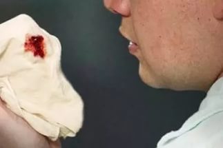 Как лечить эхинококкоз легких у человека