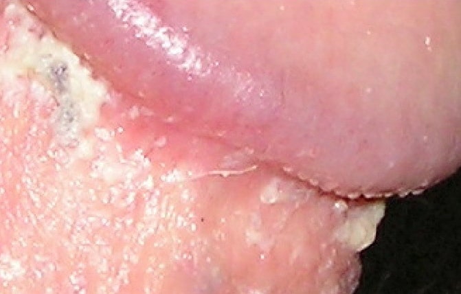 simptomy-kandidoza-u-muzhchin