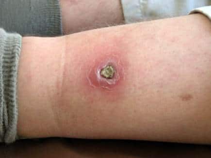 Как развивается и возникает висцеральный или кожный лейшманиоз?