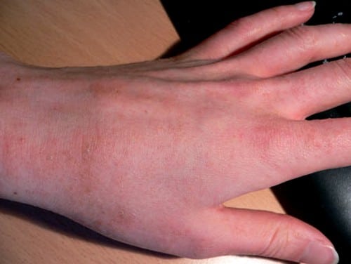 Может ли развиться саркоптоз у человека?