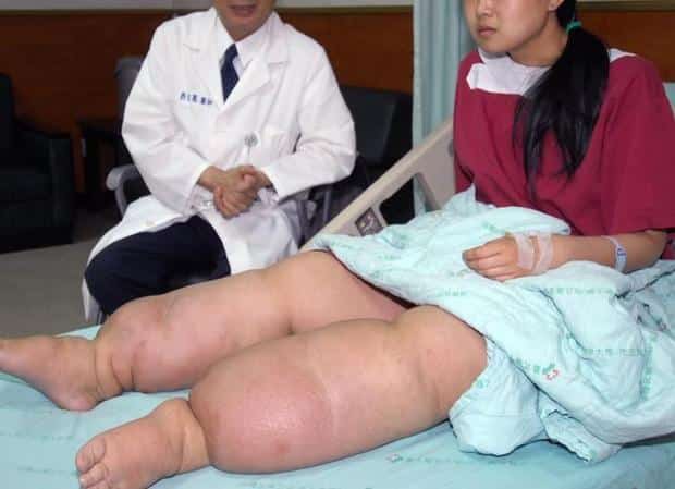 Слоновая болезнь: развитие, симптомы и лечения