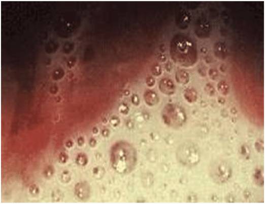 Как проявляется трихомониаз: симптомы у женщин и диагностика болезней?