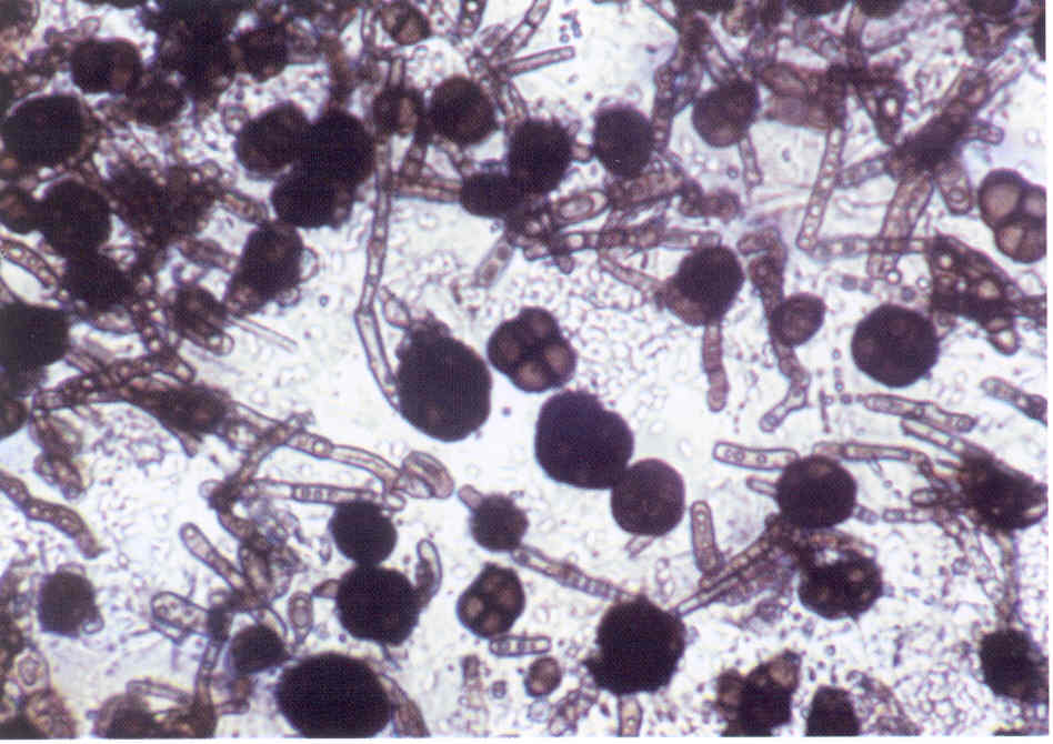 sistemnyj-kandidoz-parozhaet-vnutrennie-organy
