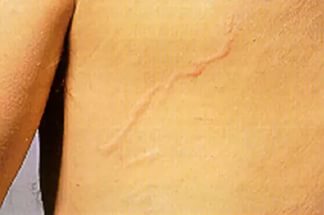 Стронгилоидоз: причины, симптомы и лечение