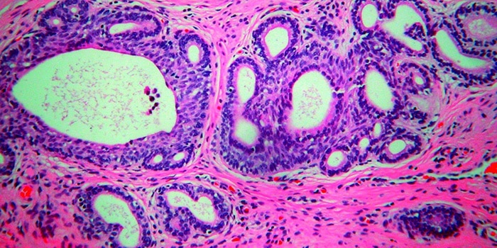 Как лечить урогенитальный трихомониаз?