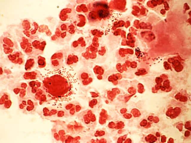 Как проявляется трихомониаз: симптомы у женщин и диагностика болезней?