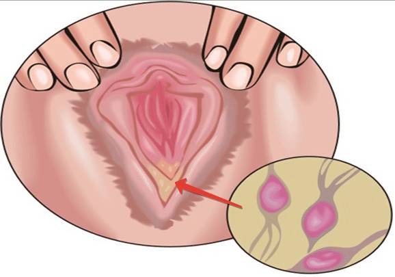 Что такое трихомониаз и как от него излечиться?