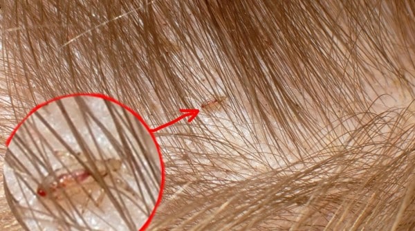 Где и как можно заразиться педикулезом?