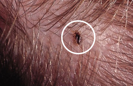 Паразиты в волосах: симптомы и меры по выведению