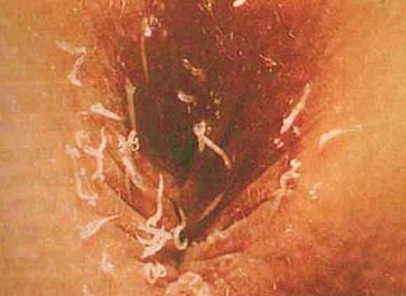 Какие встречаются паразиты в желудке у человека