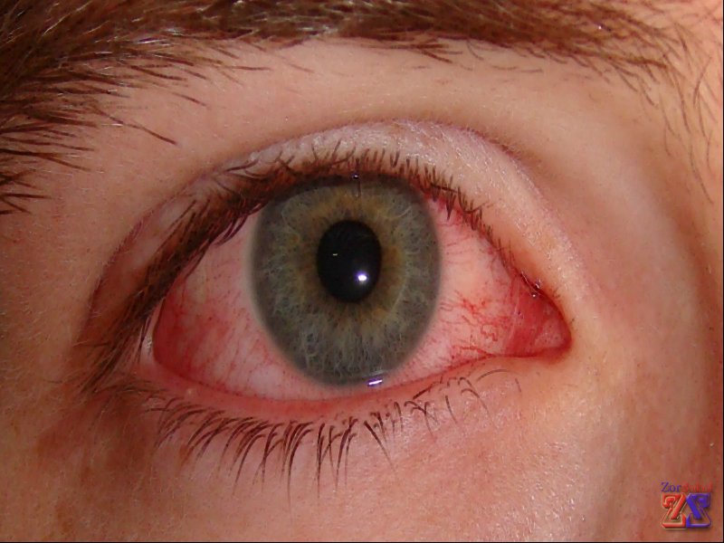 Так выглядят глаза с ССГ Так выглядят глаза с ССГ
