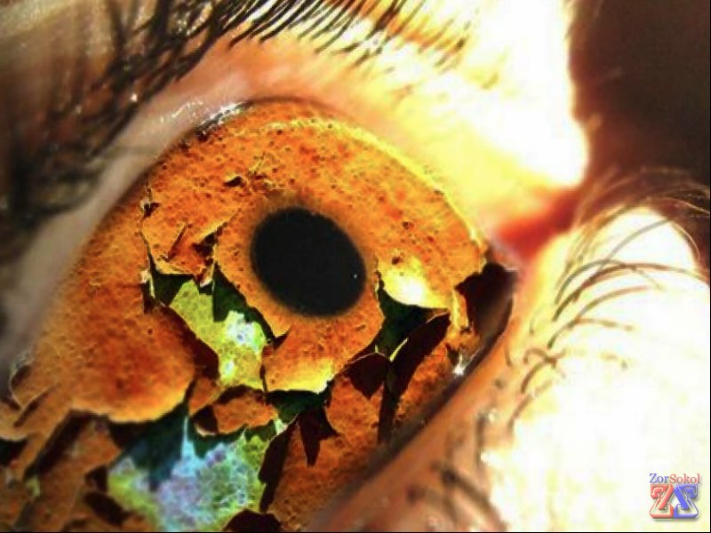 Основной симптом - сухость глаз Основной симптом - сухость глаз