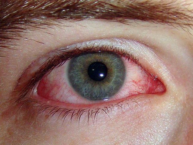 Аллергический конъюнктивит