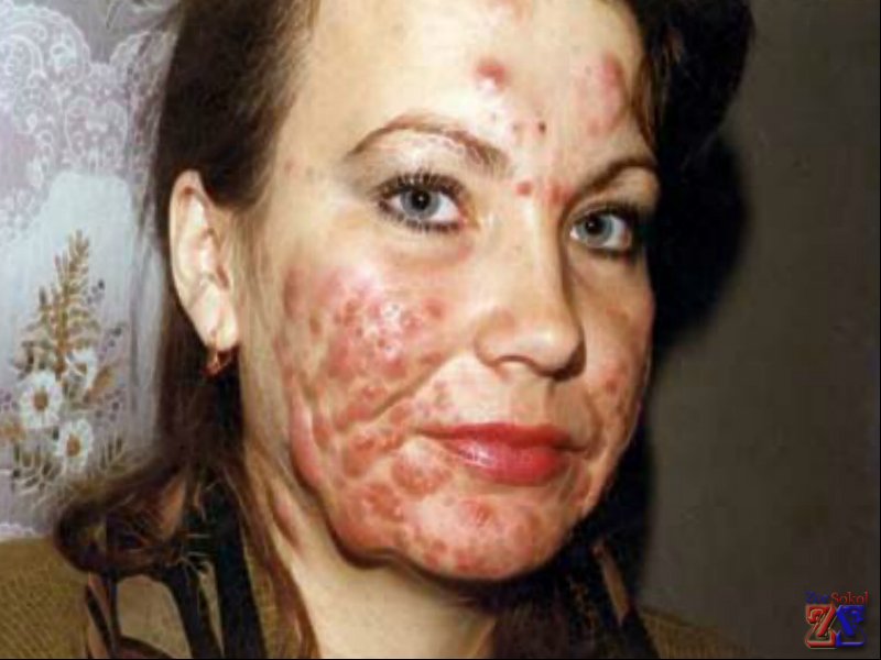 Иногда воспаление может приобретать вид "апельсиновой корки" Иногда воспаление может приобретать вид "апельсиновой корки"