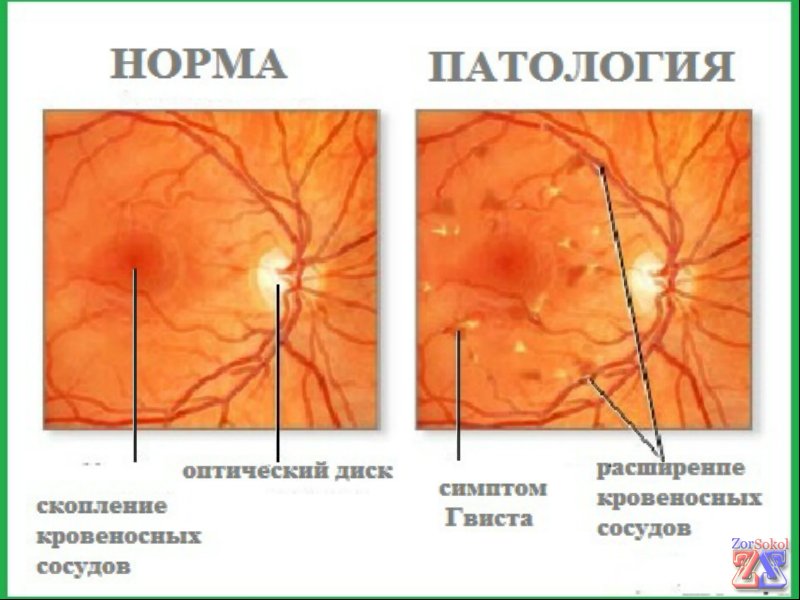 Видимые изменения при исследовании глазного дна Видимые изменения при исследовании глазного дна