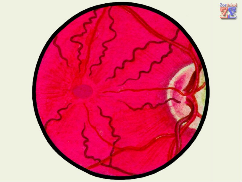 Гипертоническая форма ангиопатии Гипертоническая форма ангиопатии
