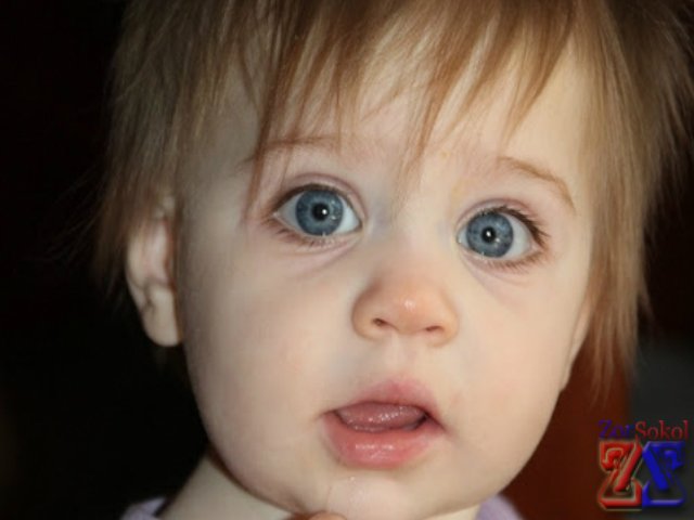 Анизокория у ребенка Анизокория у ребенка