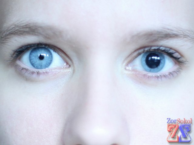 Анизокория у взрослого Анизокория у взрослого