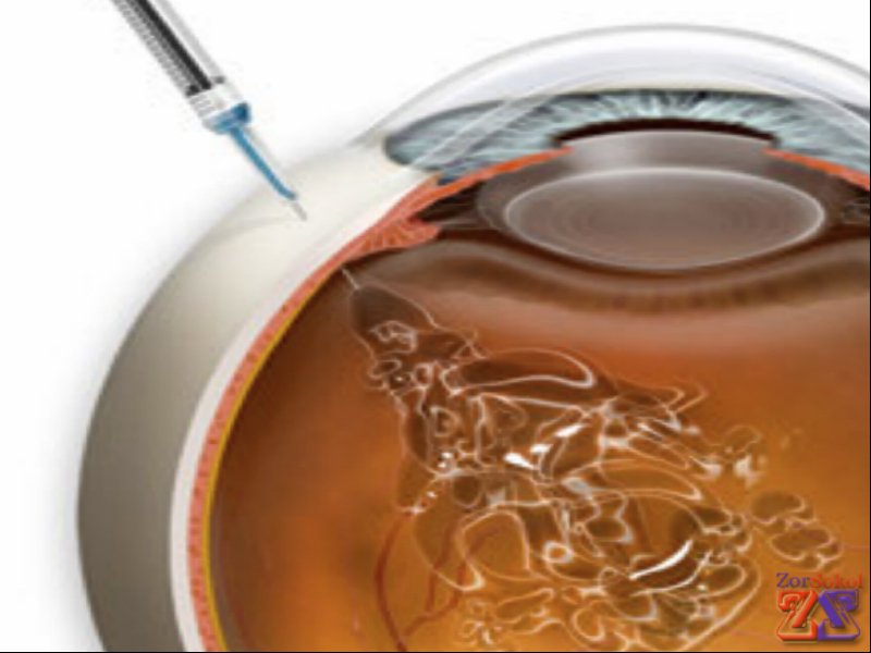 Внутриглазная инъекция Внутриглазная инъекция