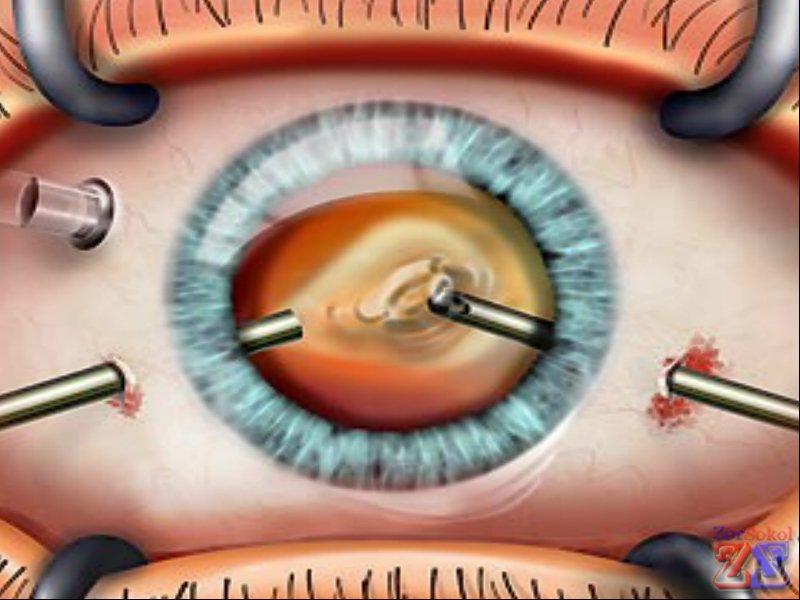 Витрэктомия Витрэктомия