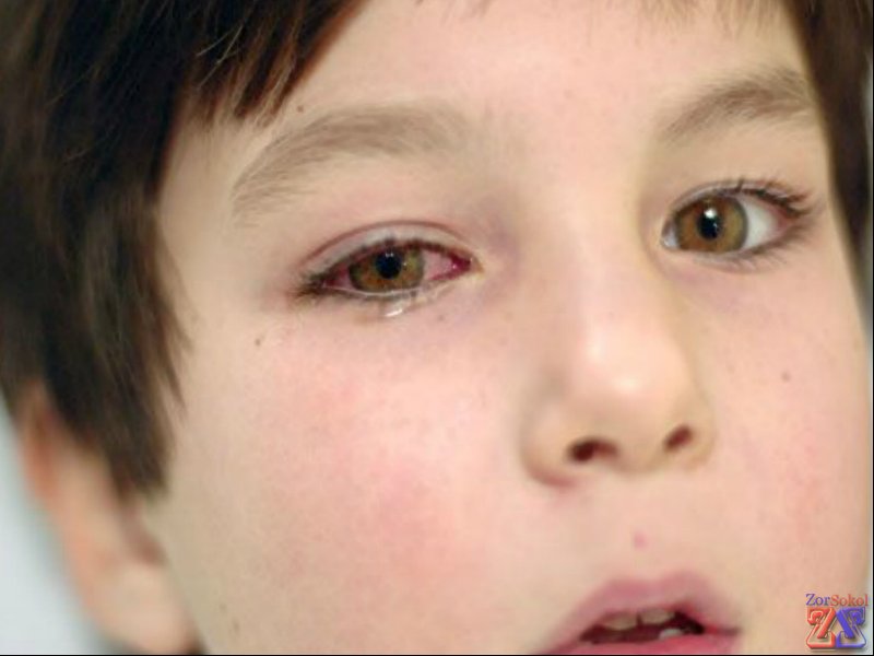 Сначала воспаляется один глаз Сначала воспаляется один глаз