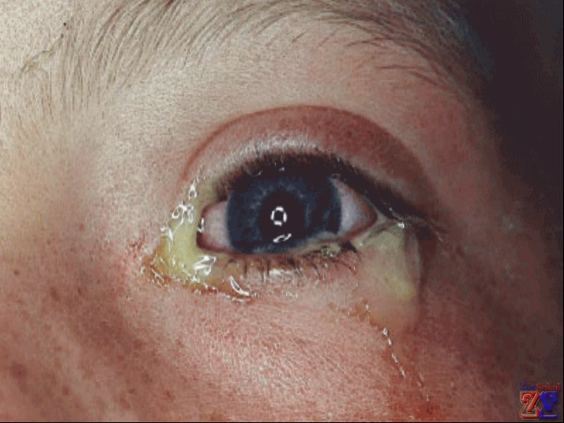 Признаки острой формы конъюнктивита - гнойно-слизистые выделения Признаки острой формы конъюнктивита - гнойно-слизистые выделения