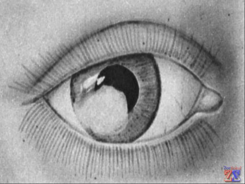 Лейкома - рубец после травмы глаза Лейкома - рубец после травмы глаза