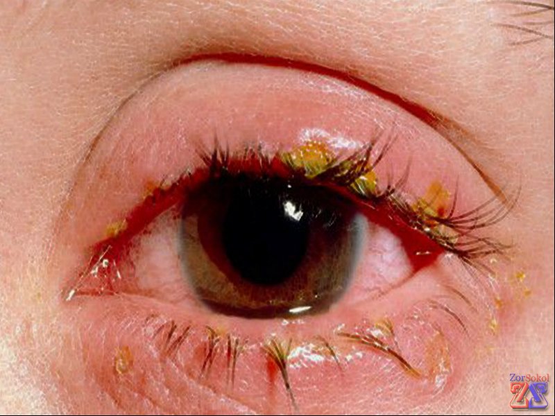 Воспаление краешков век у людей Воспаление краешков век у людей