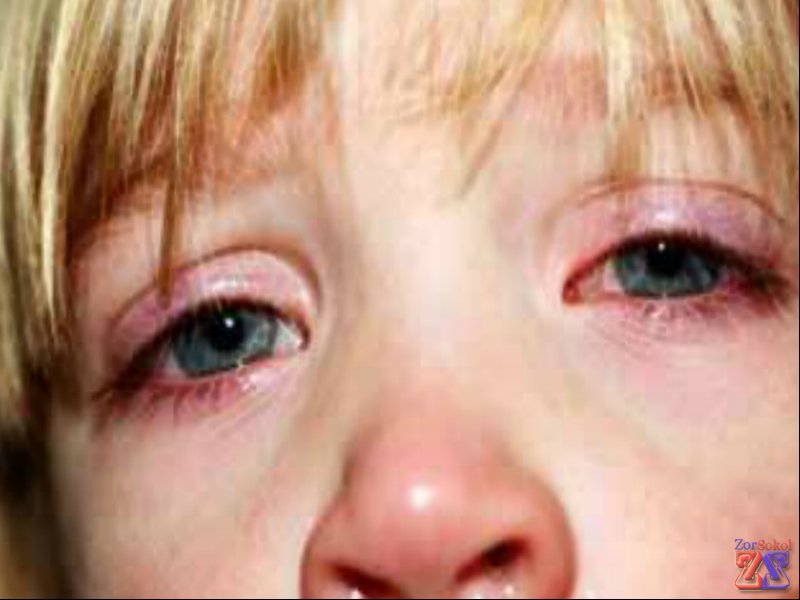 Первые симптомы: зуд, покраснение и утолщение век Первые симптомы: зуд, покраснение и утолщение век