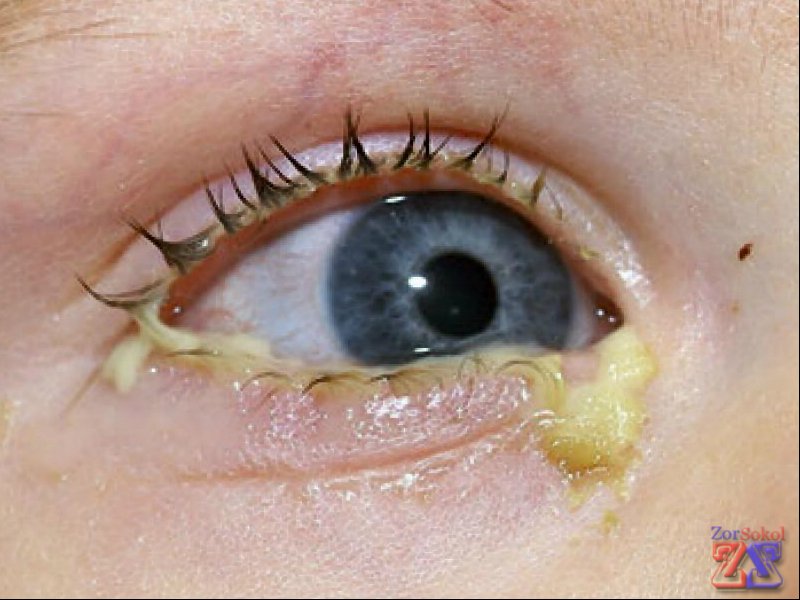 Инфекционный конъюнктивит Инфекционный конъюнктивит