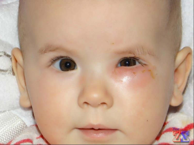 Патология слезовыводящих путей Патология слезовыводящих путей