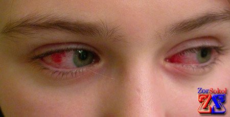 Болезнь в начальной стадии Болезнь в начальной стадии