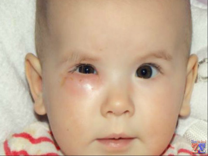 Новорожденные часто страдают дакриоциститом из-за остатков эмбрионального эпителия Новорожденные часто страдают дакриоциститом из-за остатков эмбрионального эпителия