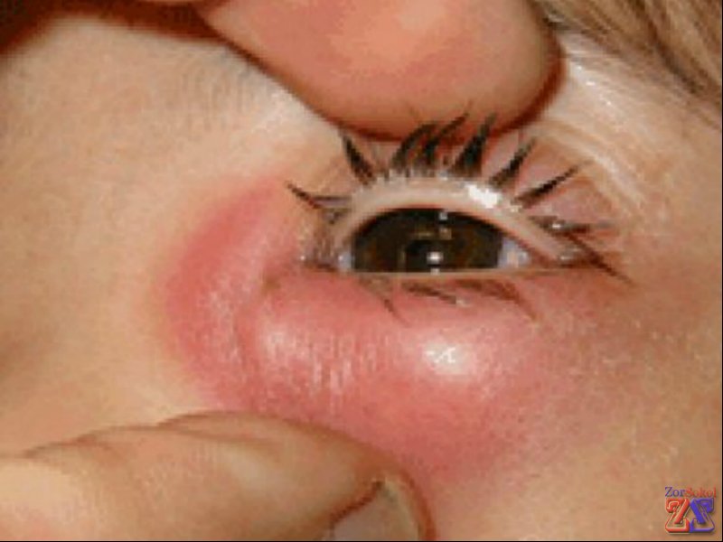 У взрослого человека и ребенка признаки дакриоцистита одинаковые У взрослого человека и ребенка признаки дакриоцистита одинаковые