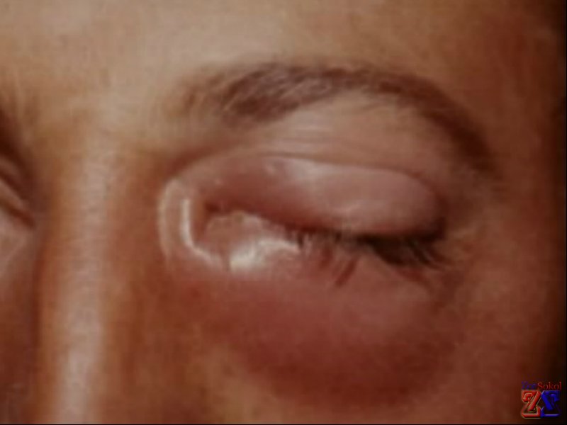 Воспаление слезного канала у взрослого Воспаление слезного канала у взрослого