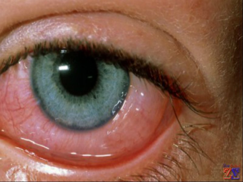 Показания - не гнойные воспаления глаз Показания - не гнойные воспаления глаз