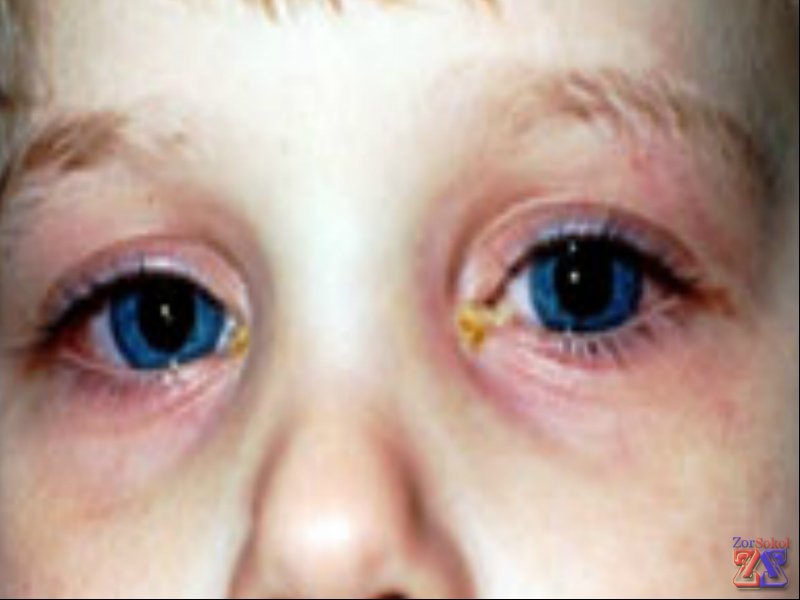 Основные признаки болезни - покрасневшие и отекшие веки Основные признаки болезни - покрасневшие и отекшие веки