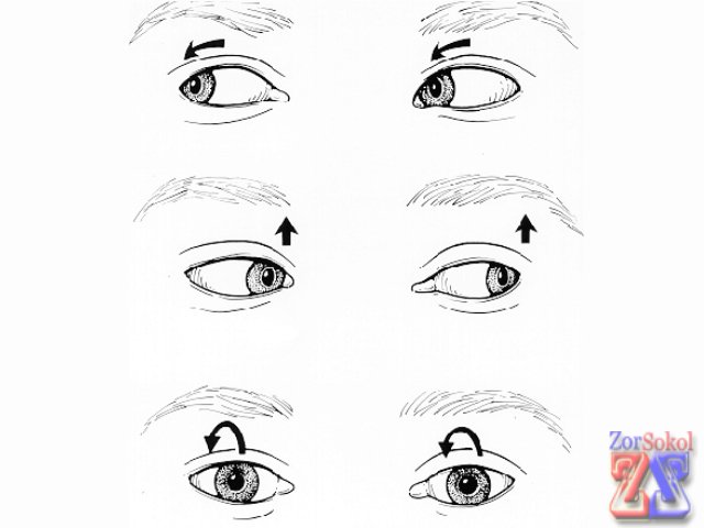 Нистагм Нистагм