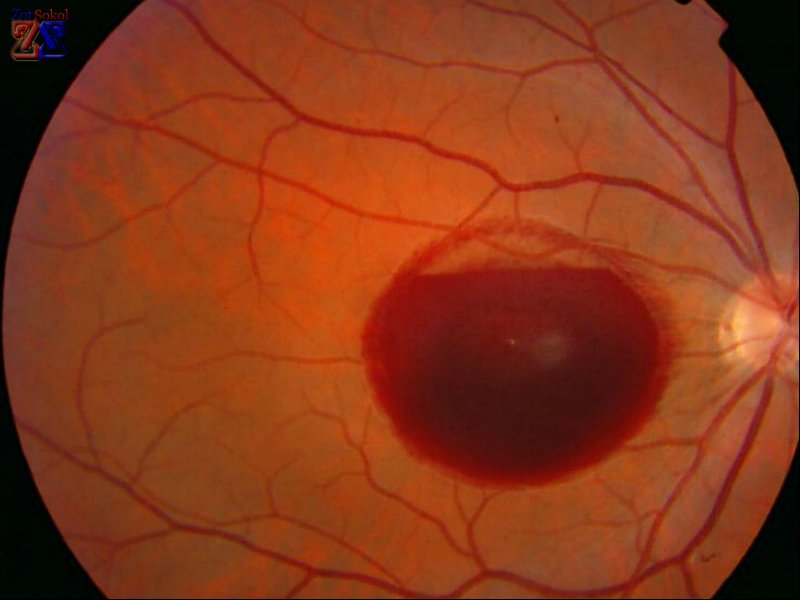 Изображение дистрофии сетчатой оболочки Изображение дистрофии сетчатой оболочки