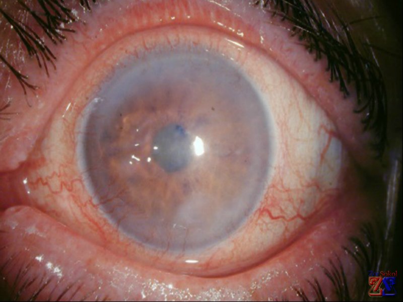 Один из симптомы роговичной дистрофии - помутнение Один из симптомы роговичной дистрофии - помутнение