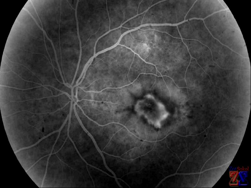 Снимок центральной хориоретинальной дистрофии Снимок центральной хориоретинальной дистрофии