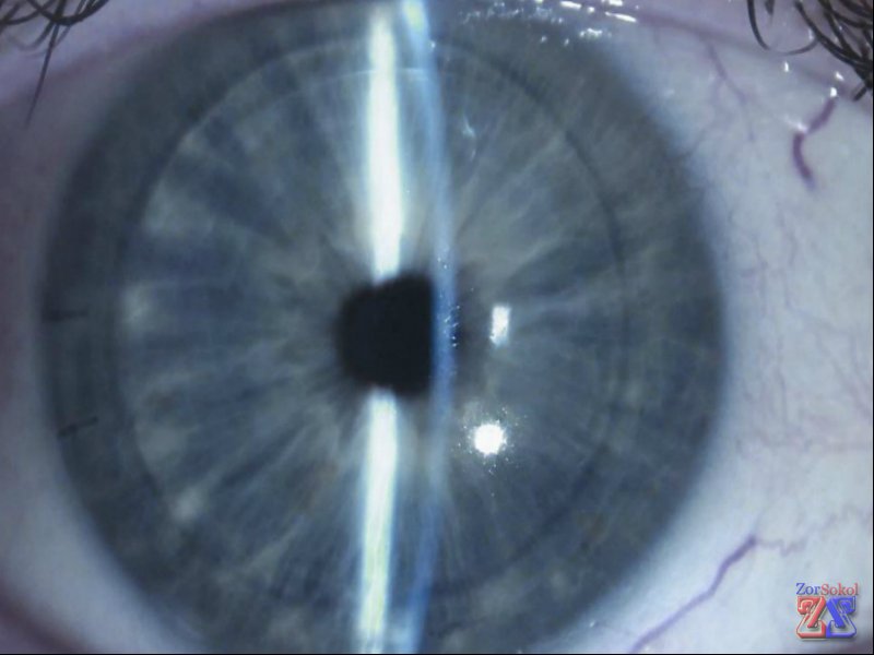 Отечная кератопатия Отечная кератопатия