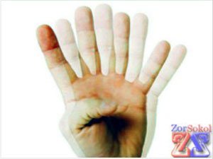 Симптомы диплопии Симптомы диплопии