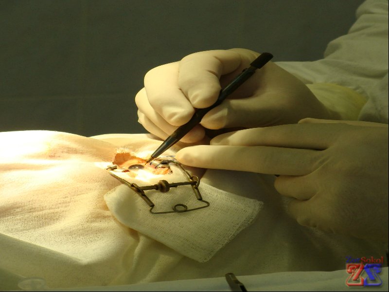 Первая имплантация Первая имплантация