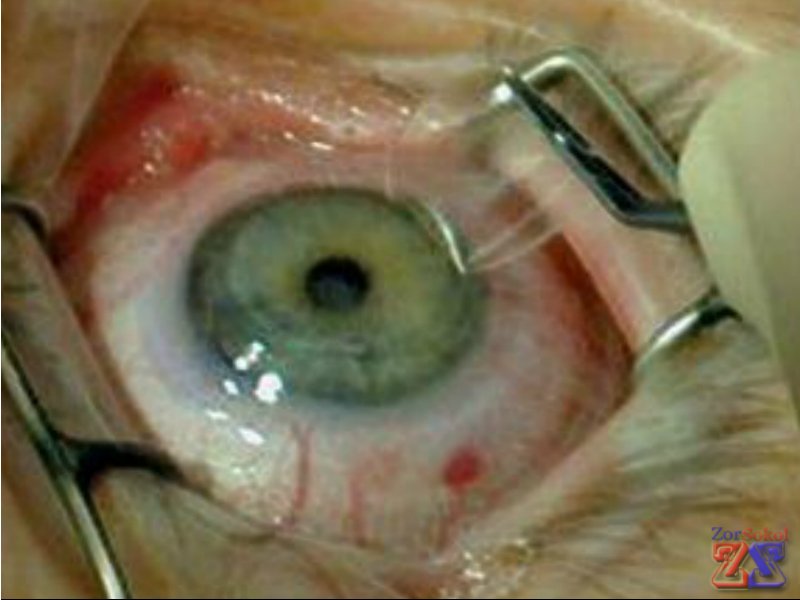 Глаз расширяется векорасширителем Глаз расширяется векорасширителем